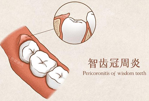 智齿冠周炎漫画示意图 智齿冠周炎漫画示意图