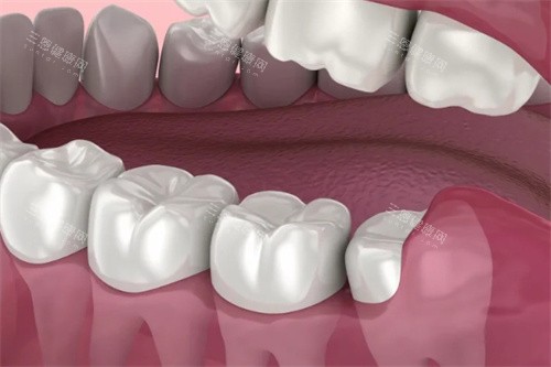 牙龈包裹住智齿 牙龈包裹住智齿