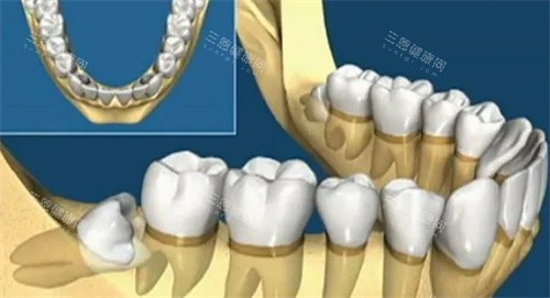 智齿牙齿动画图 智齿牙齿动画图