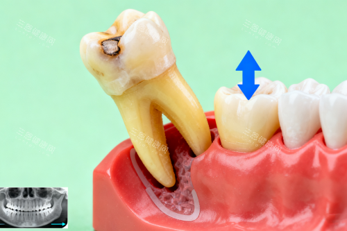 智齿拔除卡通展示图 智齿拔除卡通展示图