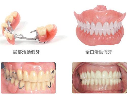 假牙價格大公開！詳細價格表！從基礎款到高端定制，讓你不再被價格迷惑！