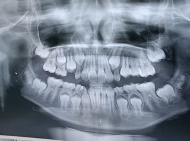 種牙前為什麽要拍片面診? 避免種植風險的有效方法