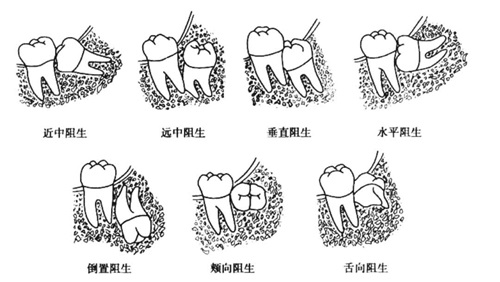 香港拔智齒一顆得幾多錢？普通智齒|正位智齒|埋伏阻生智齒價格解析~