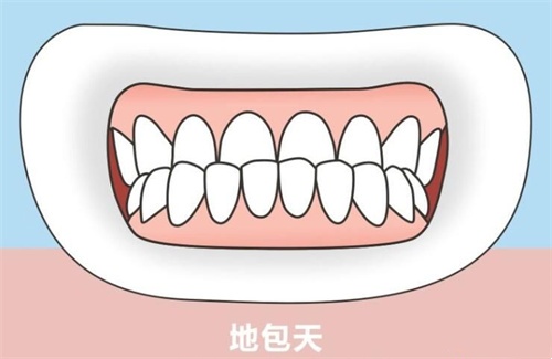 地包天示意图