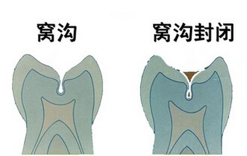 窝沟及窝沟封闭示意图