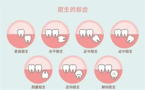 不同類型的阻生智慧齒漫畫圖