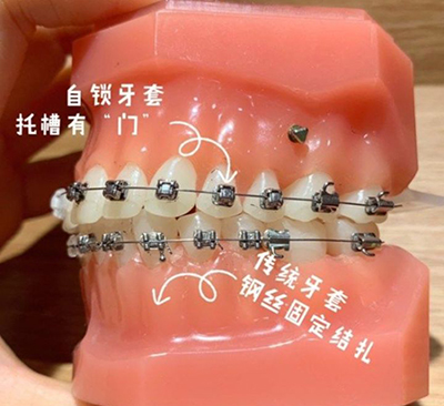 傳統&自鎖矯正圖