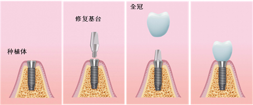 種牙面診嘅完整步驟指南：教你喺種牙路上更加安心同從容