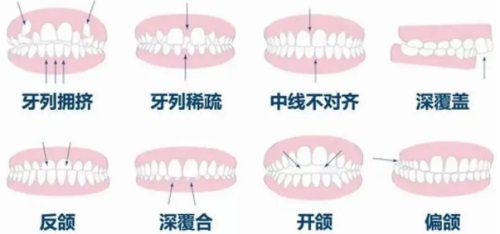 香港箍牙收費標準幾多錢啊？收費範圍大致喺兩萬至六萬港紙之間啦！