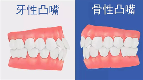 12岁孩子骨性龅牙矫正疼吗？2025孩子骨性龅牙矫正价格表+医生选择避坑指南！