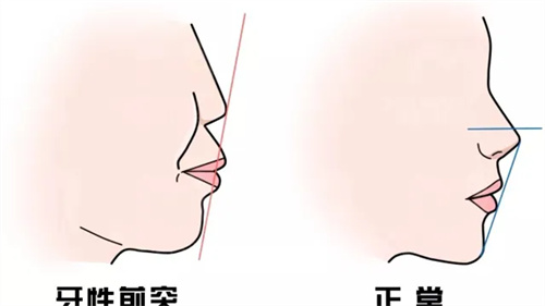 牙性前凸与正常面型对比