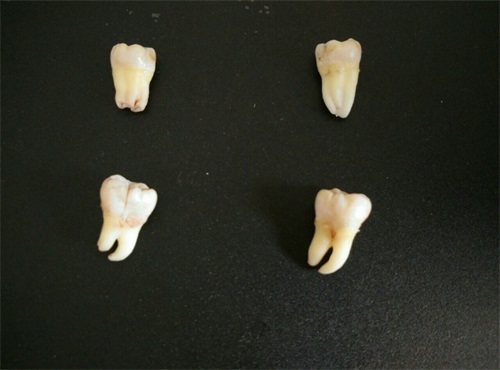 拔牙必看！智慧齒困擾難消？一文帶你了解深圳拔智慧齒價錢明细，唔使花冤枉錢！