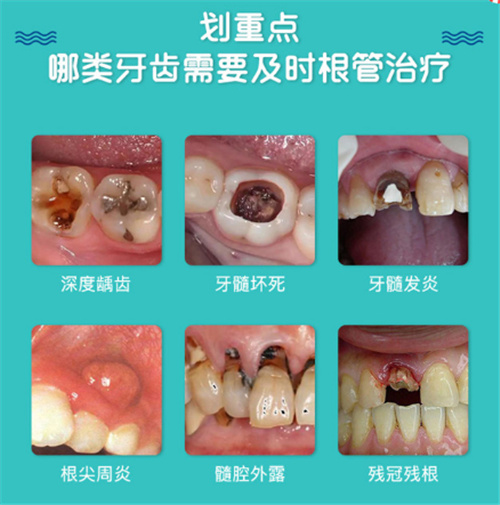 第二次杜牙根之后痛系唔系正常呀？杜牙根第二次之后会痛几耐呀？