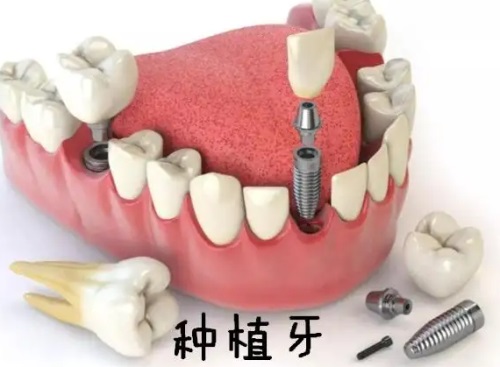 深圳牙友必看！新鮮出爐的佳美口腔價格表，矯正9999、種植4800、補牙120起，太劃算了