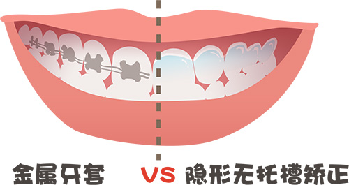 香港箍牙嘅費用系幾多呀？香港箍牙嘅價錢表呀！