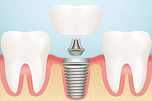 口腔种植牙卡通示意图