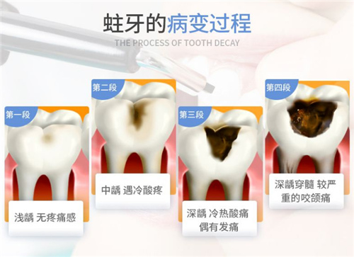 蛀牙的发展过程 蛀牙的发展过程