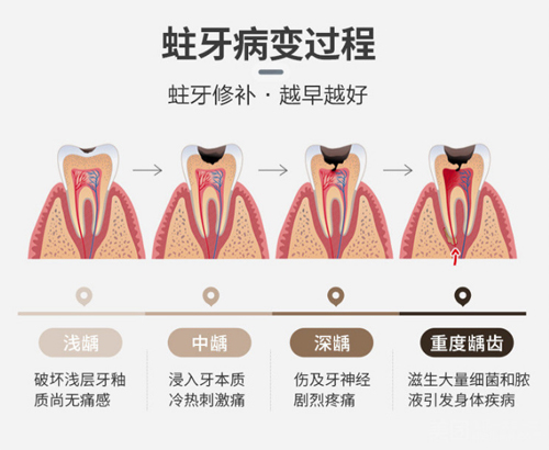 蛀牙的病变过程 蛀牙的病变过程