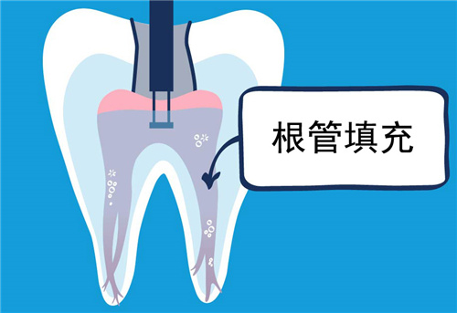 有朋友講第二次杜牙根後痛，噉点解做完根管治疗仲会痛呀？其实原因有好多！