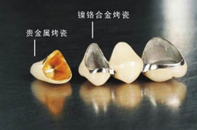 不同材质的牙冠照片
