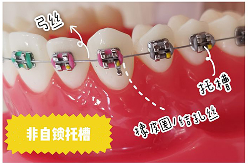 牙齿矫正非自锁托槽.jpg