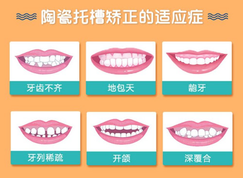 香港到深圳正畸費用攻略來襲！傳統金屬6000 - 20000元，舌側50000元起，費用參考，醫院實價為準