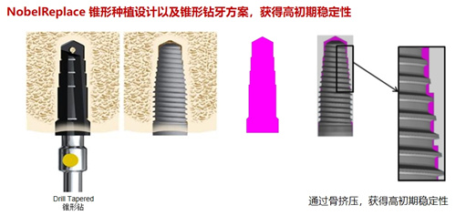 诺贝尔种植牙 (2)
