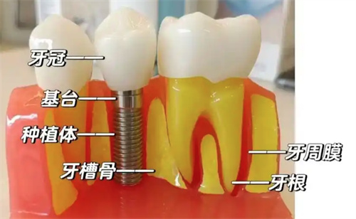 深圳康樂壹欣口腔種牙點樣？深入探究其種牙技術同收費狀況