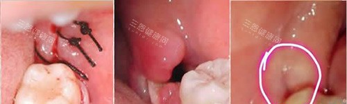 拔智齿缝合示意图