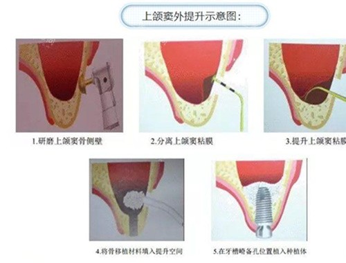 上颌窦提升过程 上颌窦提升过程