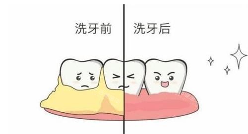 洗牙能否美白牙齒？了解洗牙嘅真正作用同牙齒美白嘅正確方法
