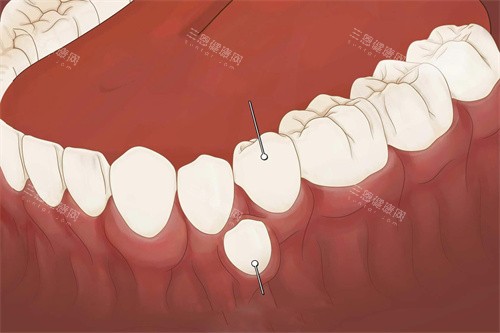 多生齒手術費用大概多少錢？一般費用會在500元到5000元之間波動~