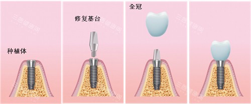种植牙过程漫画图 种植牙过程漫画图