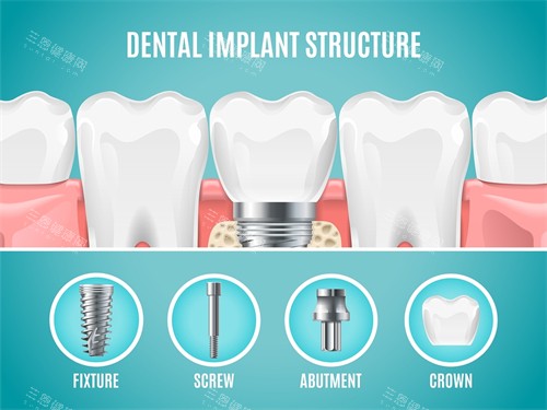 种植牙植体组成部分展示 种植牙植体组成部分展示