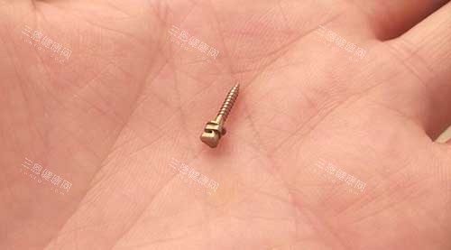 牙齿矫正骨钉种植钉3
