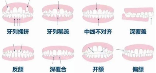2025年深圳牙齒矯正費用盤點：金屬、陶瓷、隱形矯正詳細價目表