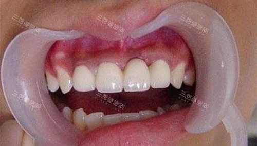 烤瓷牙后的牙齿情况