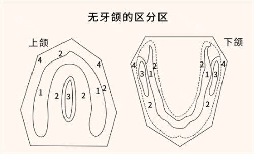 无牙颌分区图