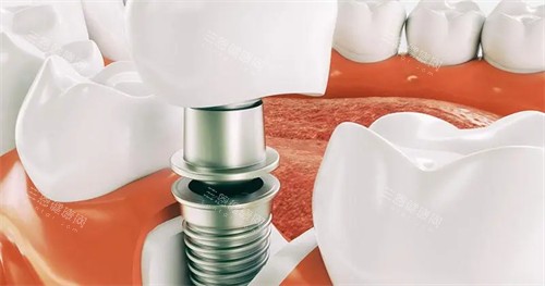 单颗种植牙演示 单颗种植牙演示
