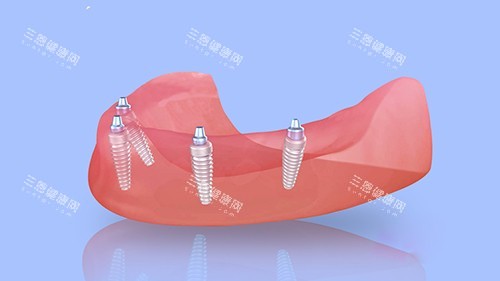 震撼!深圳蒙恩口腔做牙科好嗎?看牙體驗來佐證,優勢凸顯