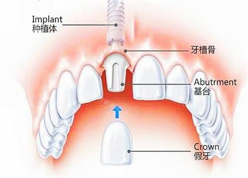 即拔即种示意图 即拔即种示意图