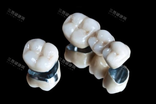 烤瓷牙冠模型图 烤瓷牙冠模型图