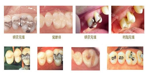 不同牙齿修补示意图 不同牙齿修补示意图