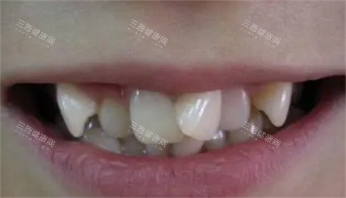 牙齿拥挤的照片