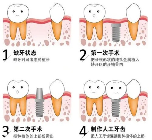 想知道瑞典諾貝爾種植牙水平？瑞典諾貝爾種植牙怎麽樣，臨床經驗十分豐富，鈦易耐技術促骨愈合