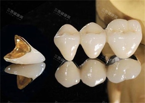单颗烤瓷牙和连冠烤瓷牙