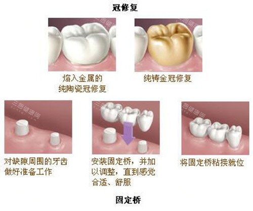 牙冠修复及固定桥展示过程