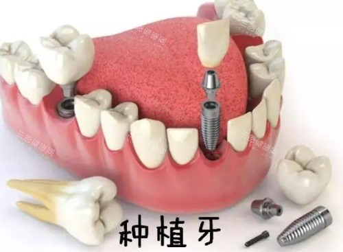 珠海牙科醫院價錢大起底，種牙、箍牙、全瓷牙、補牙收費一次看清！