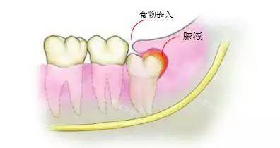 香港拔智慧齒後幾耐先可以正常飲食？牙醫實測：軟食期／硬食期時間節點參考