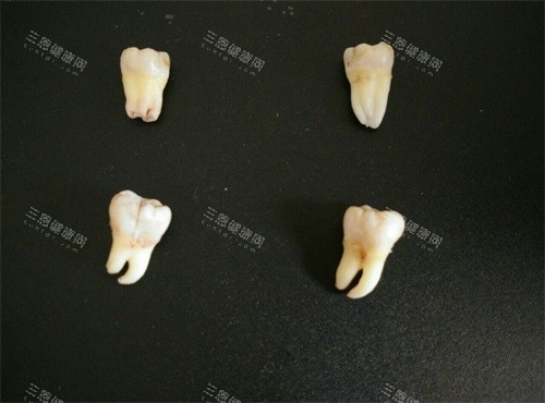 不同类型智齿实物展示图